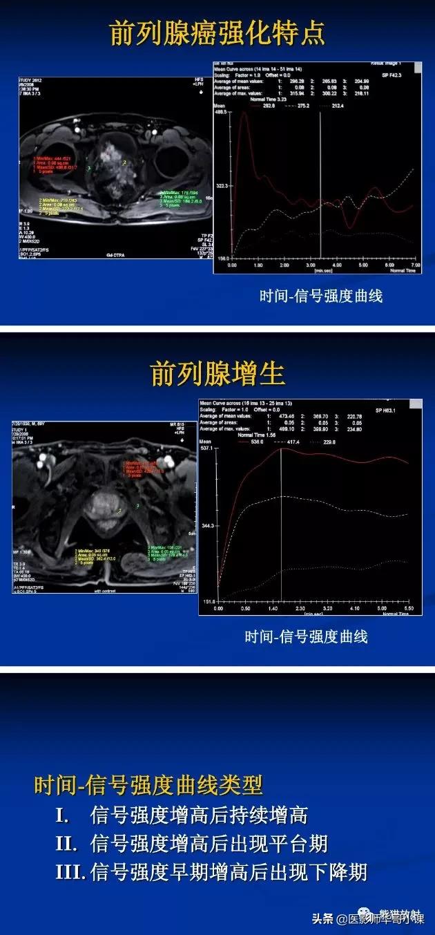 前列腺磁共振影像解剖,前列腺mri正常诊断报告模板