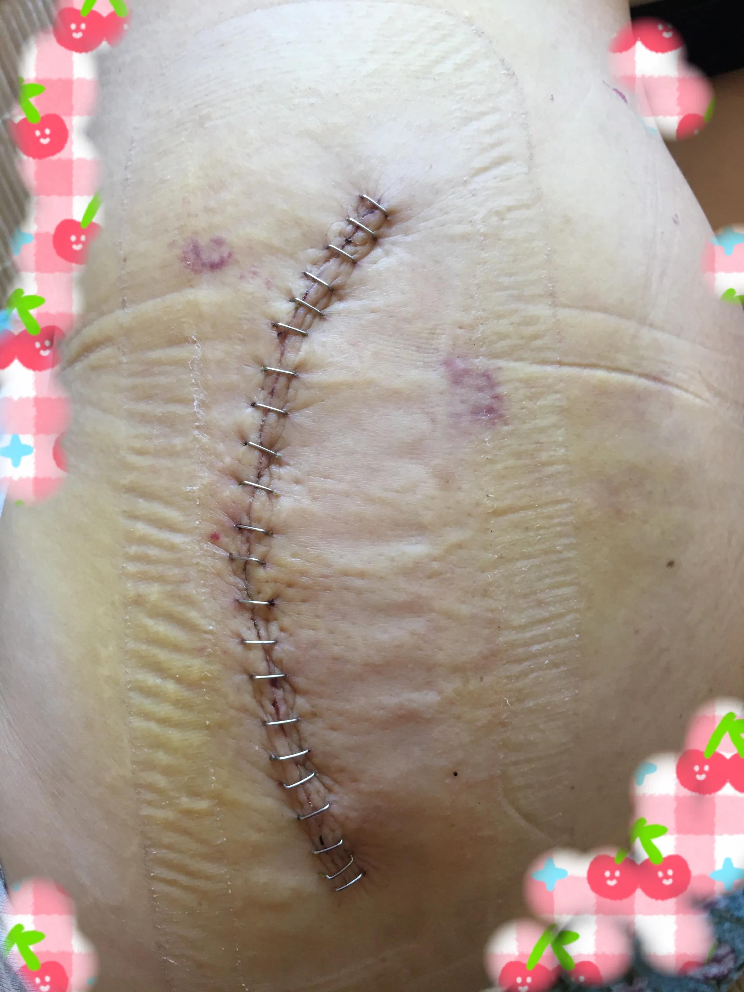 华西医院谈全髋关节置换寿命问题,华西髋关节置换术后本人真实感受