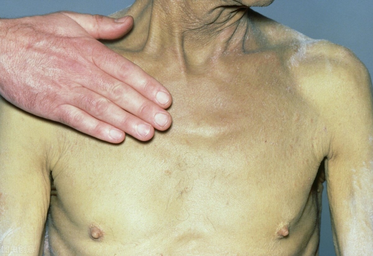 转氨酶胆红素全部升高并出现黄疸,转氨酶高黄疸高严重吗