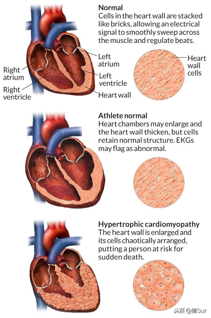 马拉松心梗猝死,马拉松心脏猝死的抢救