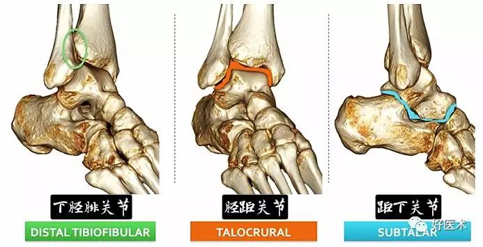 一文搞定！踝关节周围韧带的解剖及MRI特征