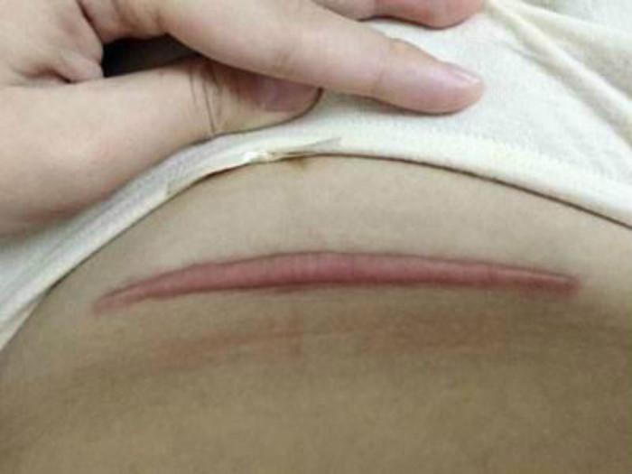 剖腹产疤痕越来越大有危害吗,剖腹产留下的疤痕有什么危害