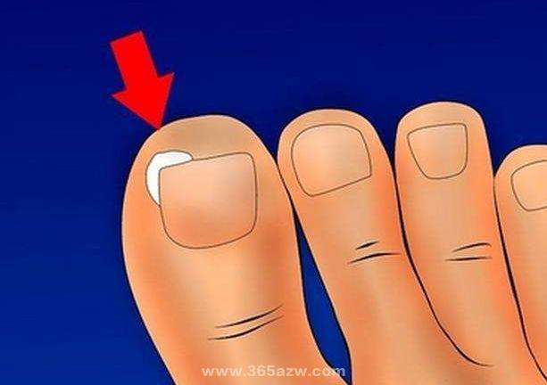 脚趾甲嵌进肉里面原因,脚趾甲长肉里拔不出来怎么办