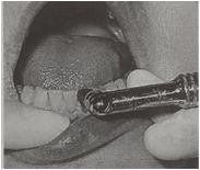 多图直击！牙医如何用抛光把孩子的牙洗干净？#葉子口腔科普#