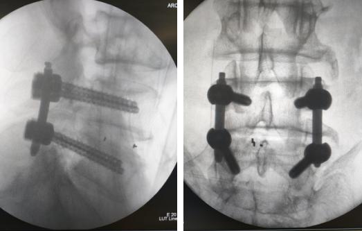 70岁大爷长期抬腿治腰椎间盘突出,腰椎间盘突出一个老头锻炼视频