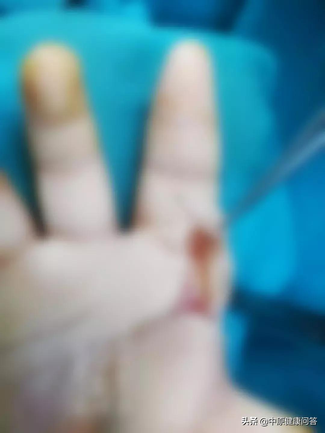 竹签扎到孩子视频,竹签插在小孩嘴里视频