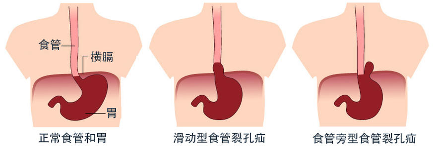 胃食管反流导致乏力恶心,胃食管反流引发吞咽困难怎么治疗