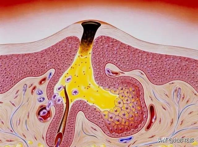 真正有效的去黑头方法,去黑头白头最有效的方法