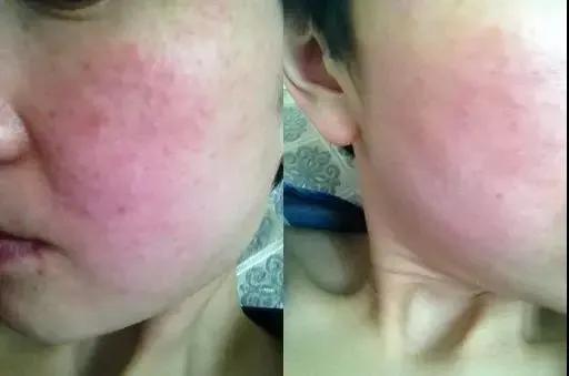 戴口罩长痘痘疹子丨如何拯救“口罩脸”