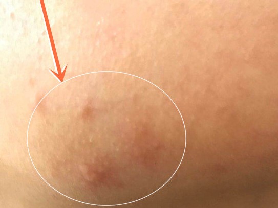 17岁女儿脸上长满痘痘，看了这篇文章才知道如何帮助她