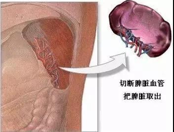 卡兰加脾脏摘除,卡兰加恢复出院