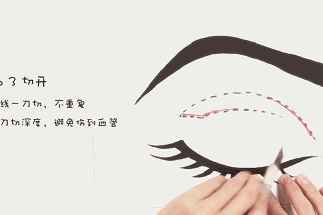 全切无痕割双眼皮,全切双眼皮原来是这么割出来的