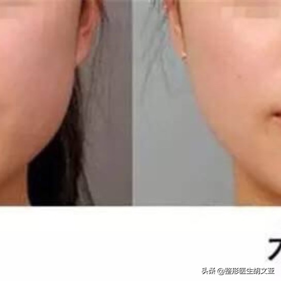 今日科普打瘦脸针前你要了解这些,打了瘦脸针前注意事项和忌口