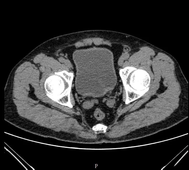 中年人血尿癌症几率是多少,老年人血尿是膀胱肿瘤吗