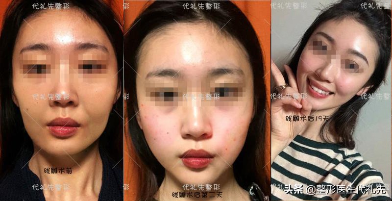 从医学来讲法令纹怎么改善比较好,整形医生怎么解决法令纹的问题