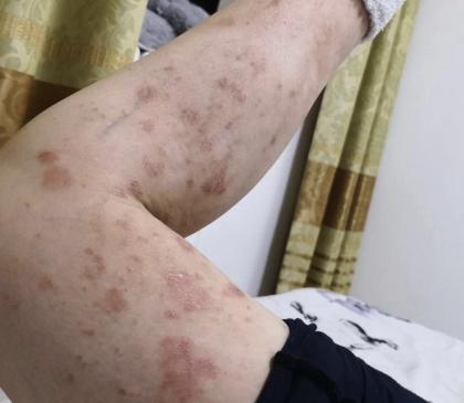 牛皮癣患者的治愈经历,牛皮癣患者亲身治愈经历