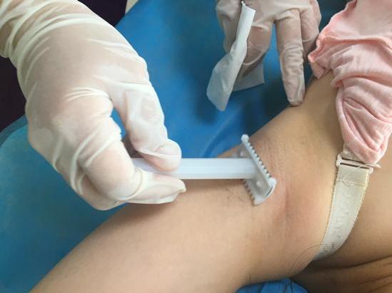 为什么顺产备皮不要刮干净,顺产还是剖腹产都要剃光头