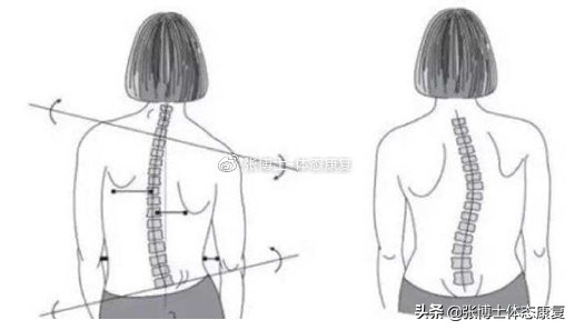 如何让青少年体态矫正,体态问题很严重去哪里矫正