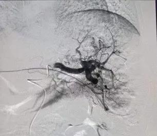 脾亢进介入治疗哪个医院好,宝宝脾功能亢进能治吗