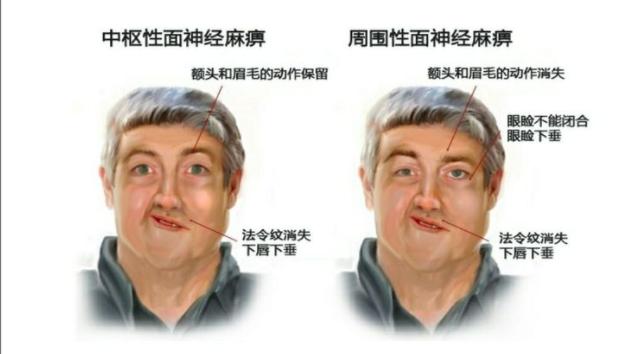 面神经炎治疗自述,面神经炎科普视频