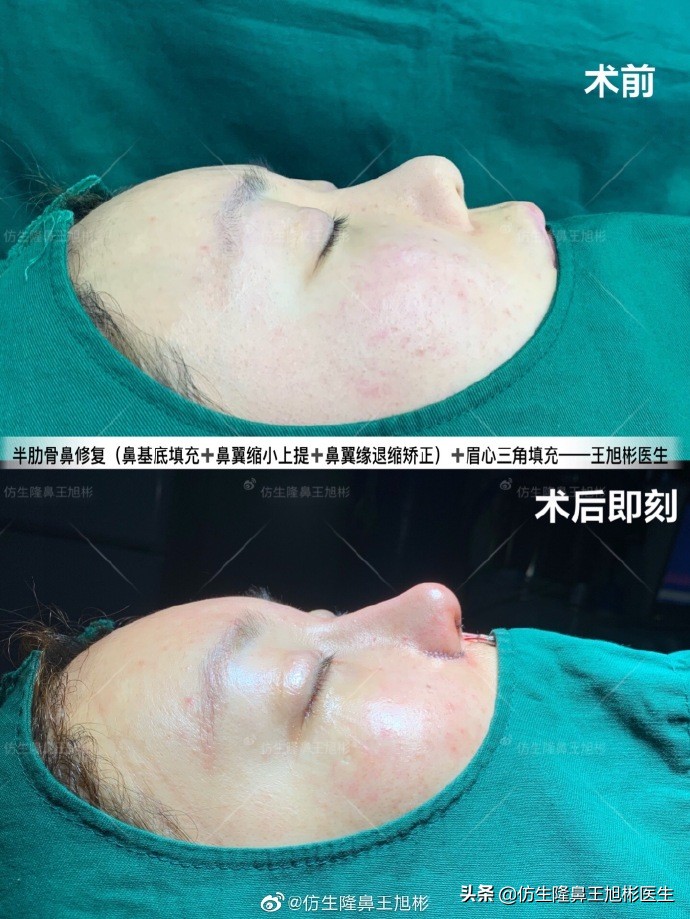 隆鼻鼻型科普,鼻基底凹陷隆鼻可以改善吗