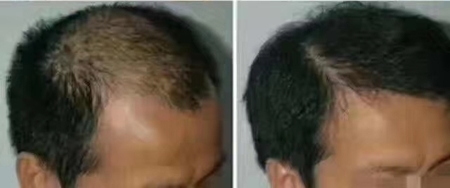 生发止脱发真实案例,脱发患者重新生发案例