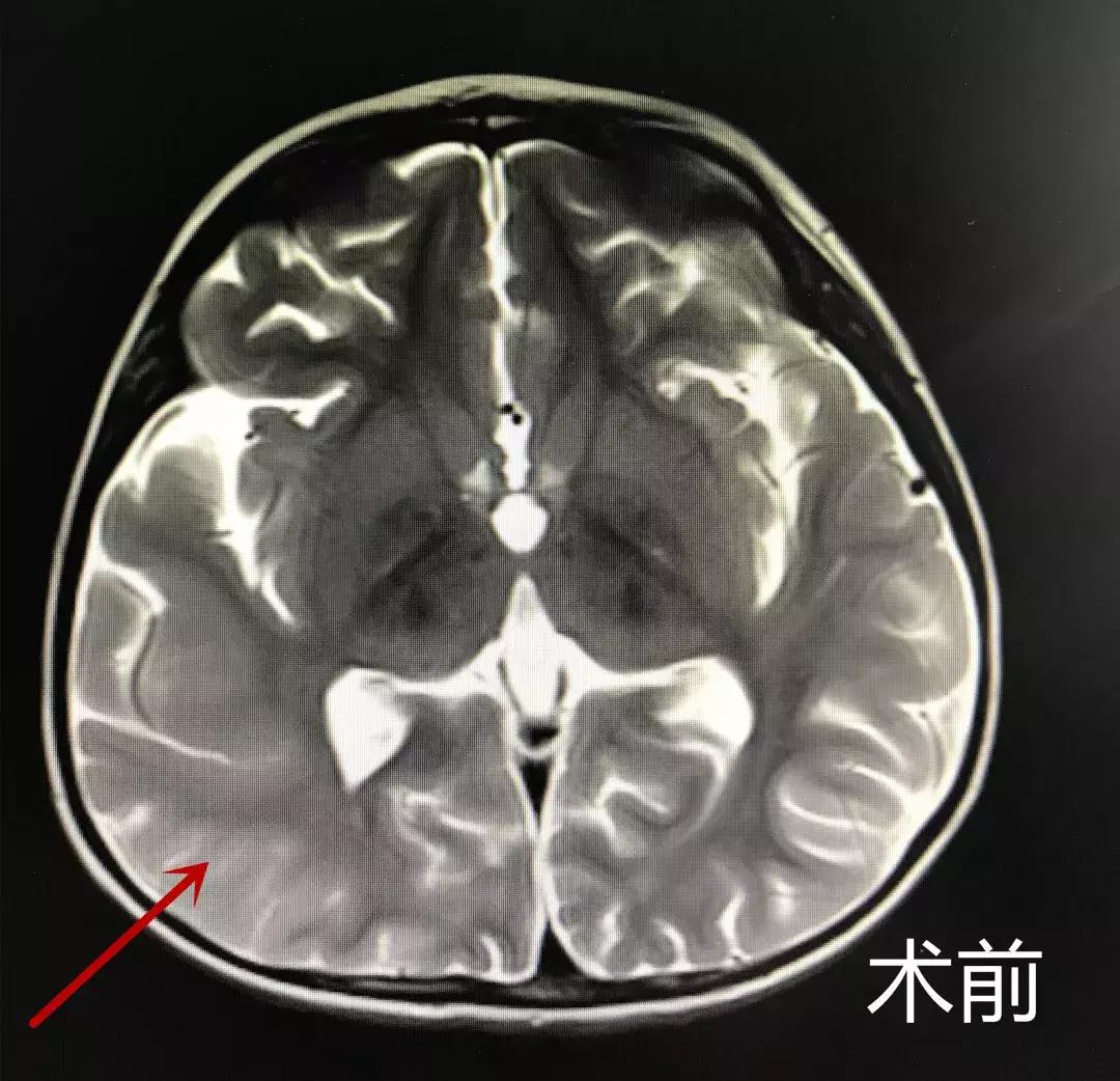 儿童癫痫可怕家长寝食难安,小孩癫痫家长的采访