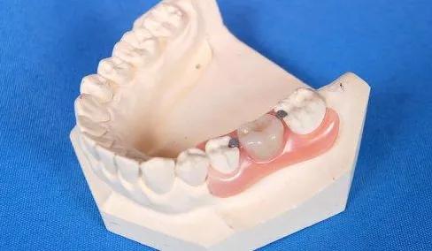 假牙松动重新粘合需要多少钱,种植牙松动可以拔掉重新种吗