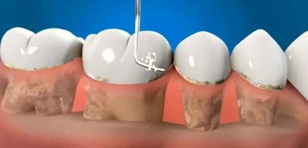 牙齿又怕冷又怕热用什么药,牙齿怕冻怎么办