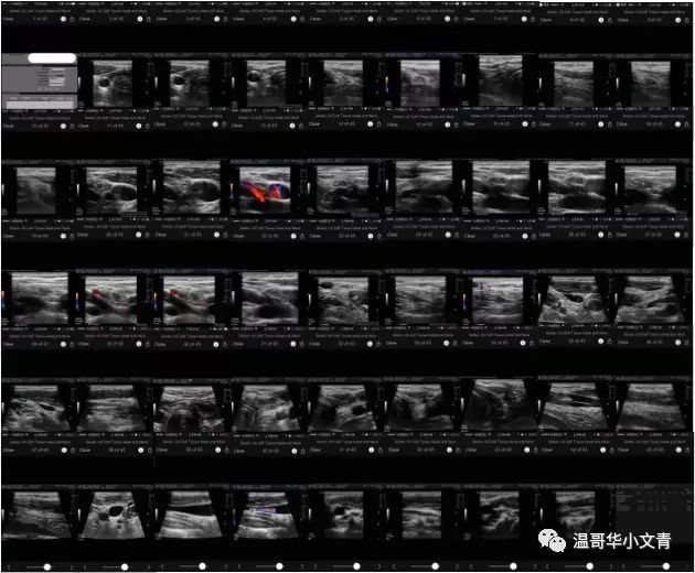 甲状腺癌术后8个月复发能活多久,甲状腺癌术后复发做131有用吗