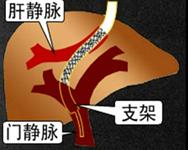 门脉高压的个体化治疗,肝前型门脉高压培训课程