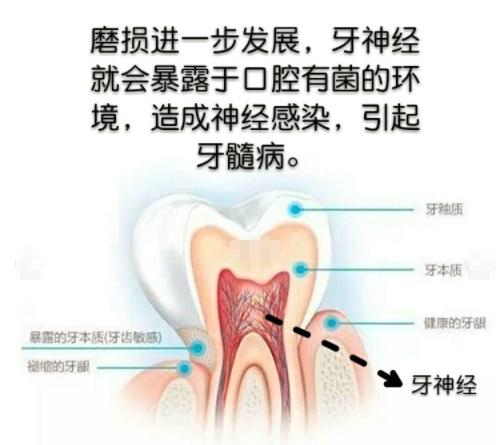 防止牙齿磨损的最佳方法,保留牙根的牙齿修复治疗