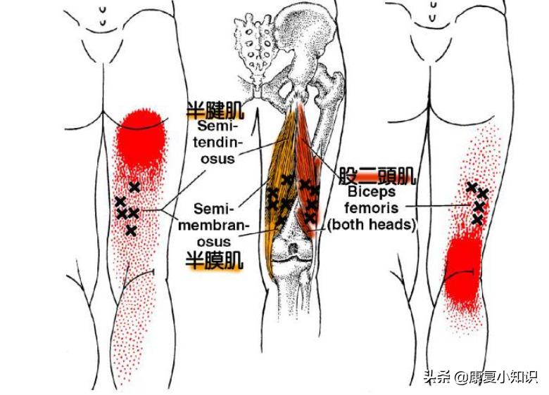 大腿后侧疼痛的位置图,大腿后侧根部疼痛