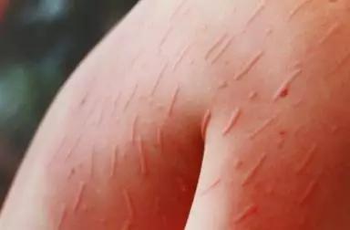 城市温度急剧上升,冬天温度高皮肤干燥瘙痒怎么办