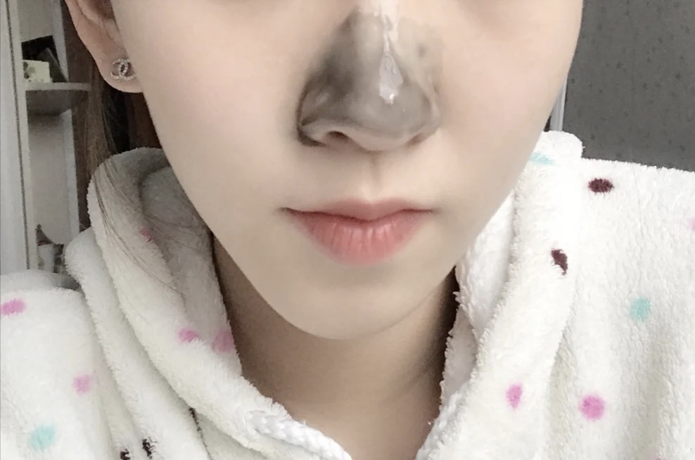 去黑头酒糟鼻有什么好的药膏,酒糟鼻祛黑头