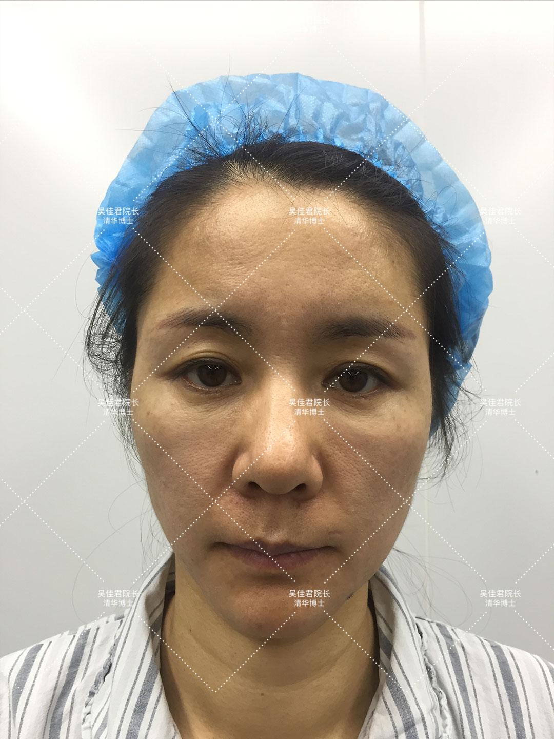 拉皮手术后三个月的恢复过程,拉皮术后10天白天可以不戴头套吗