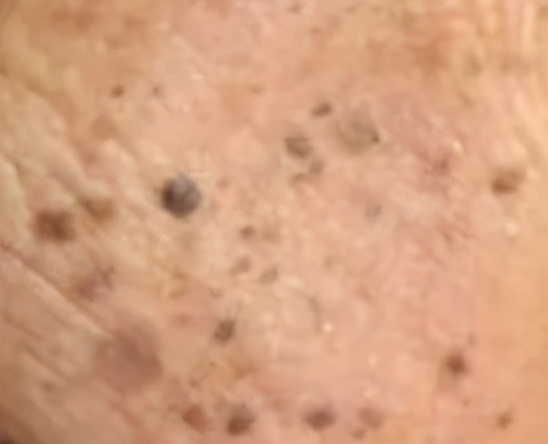 脸上长了闭口小颗粒怎么去除,脸上白色颗粒怎么去除