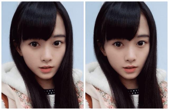 颧骨高太阳穴凹陷怎么改善脸型,颧骨宽大太阳穴凹陷快速改善