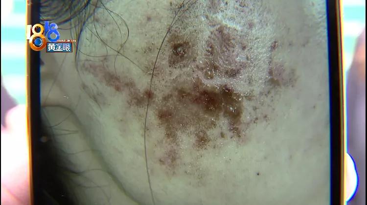 光子嫩肤后满脸黑点,光子嫩肤结痂想化妆怎么办