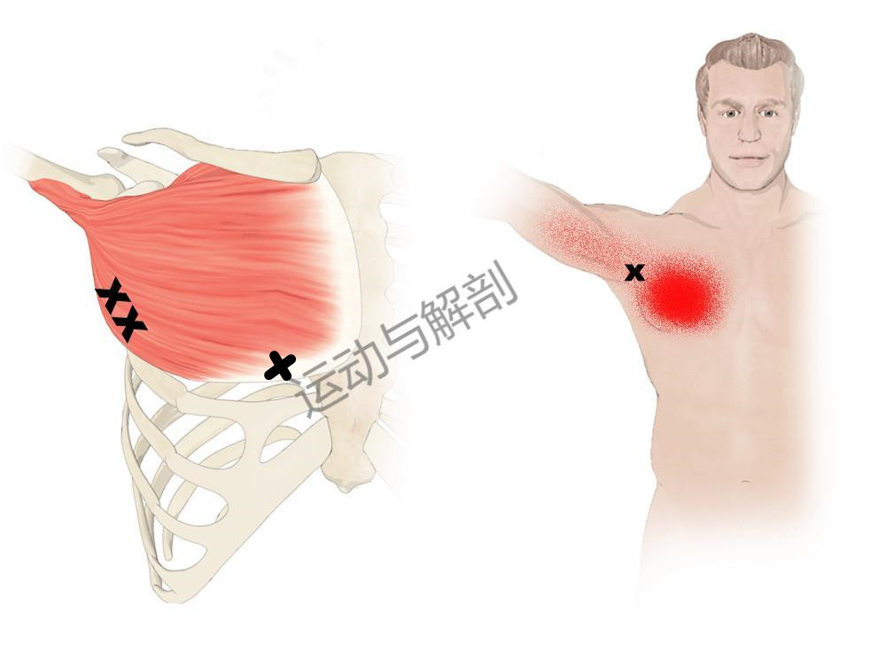 胸大肌肌肉撕裂怎么更快恢复,胸大肌疼痛怎么消除