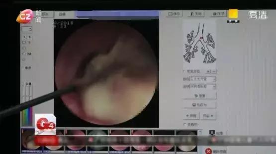 女子咳嗽20年竟因鸡骨头卡气管,大人痰卡住气管急救方法