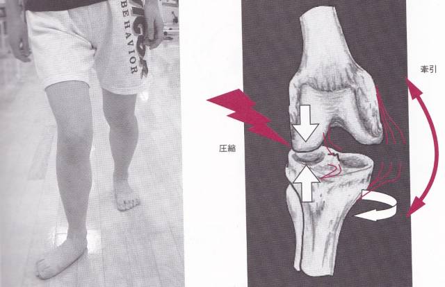 跑步时脚是外八字怎么纠正,膝盖内扣脚外八字跑步