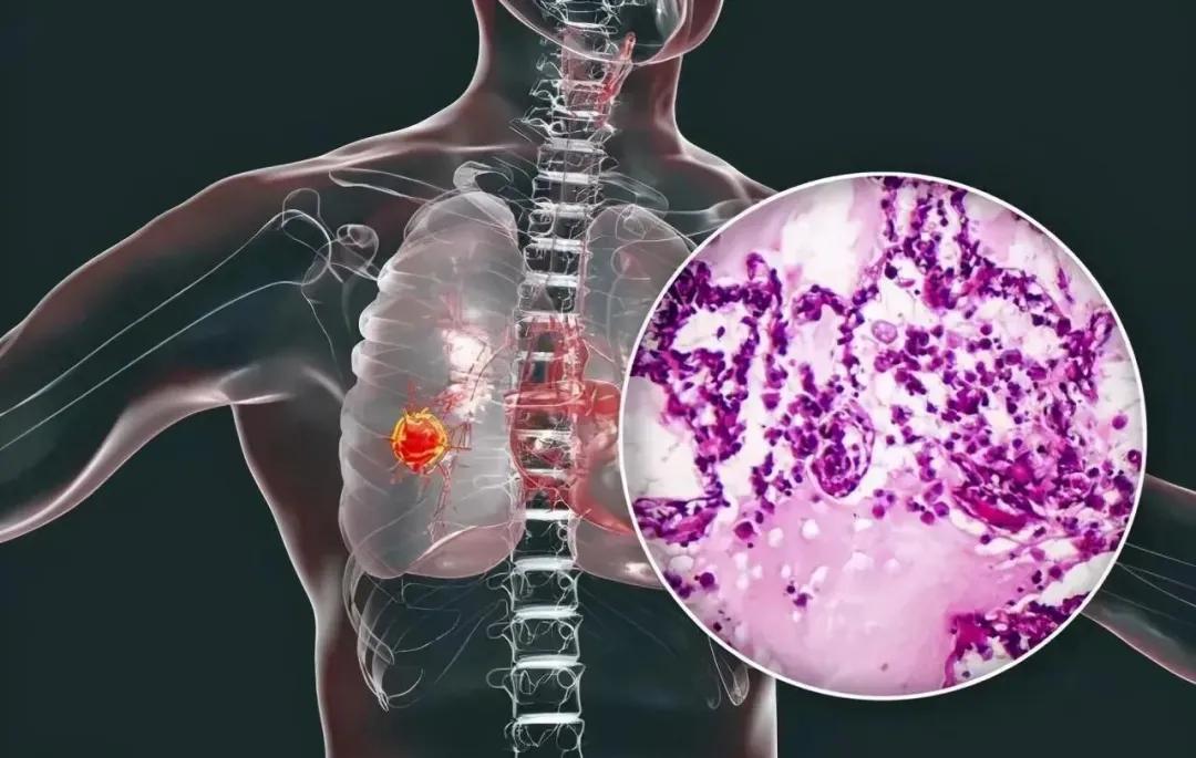 肺大细胞神经内分泌癌综合治疗进展