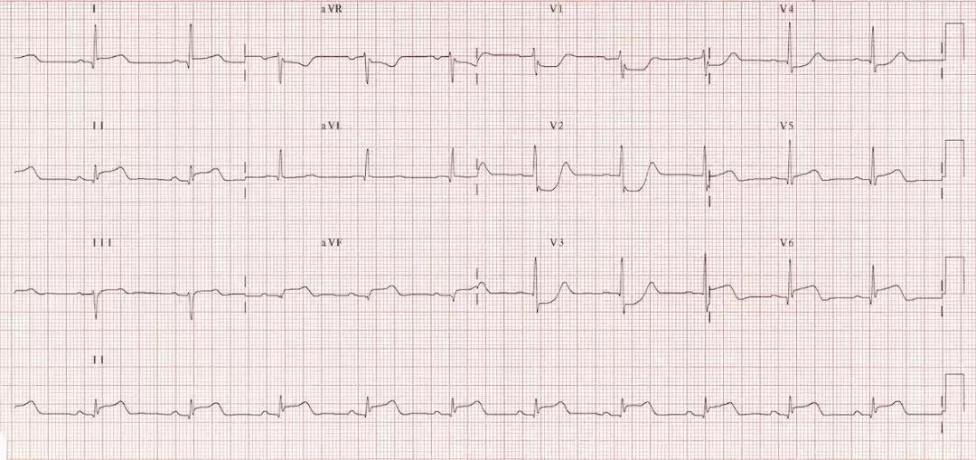 心电图和心脏彩超以哪个为准,心电图和心脏超声是一样吗