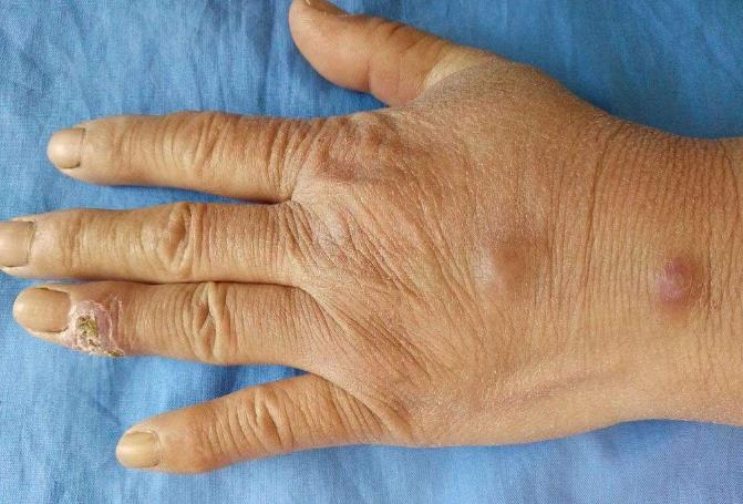 最常见的皮肤癣菌病是哪一种菌,孢子菌感染皮肤病怎样治疗