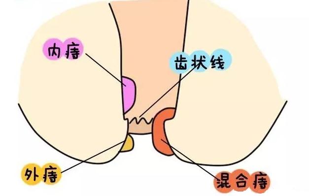 怎么判断自己有没有痔疮?医生坦言:有这5种不适,八九不离十