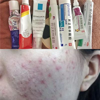 痘肌精华推荐祛痘印学生,油痘肌好用的祛痘精华推荐