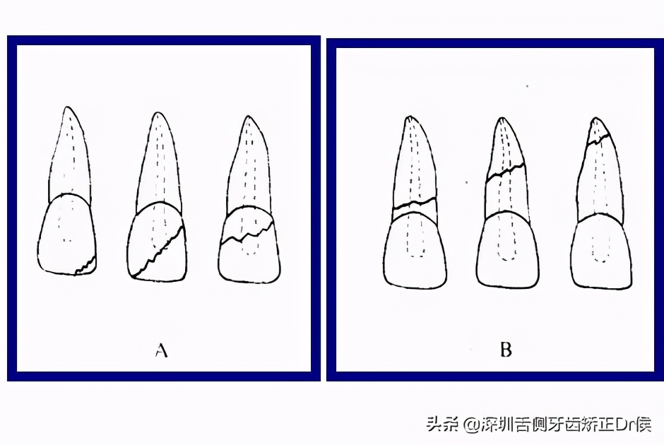 牙断了还连着肉怎么办,烤瓷牙套里的牙断了怎么办