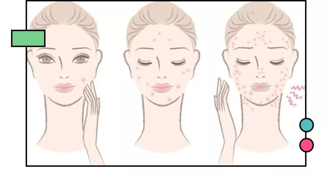 教你4个祛痘印最有效的方法,如何正确的去痘印