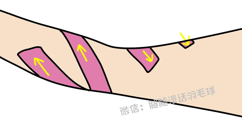 打球贴了肌效贴还用戴护膝吗,打球受伤了感觉不到疼